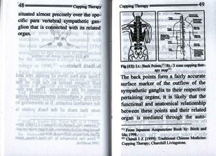 Cupping Therapy- The Ancient Art of Healing( Pocket Size)-3
